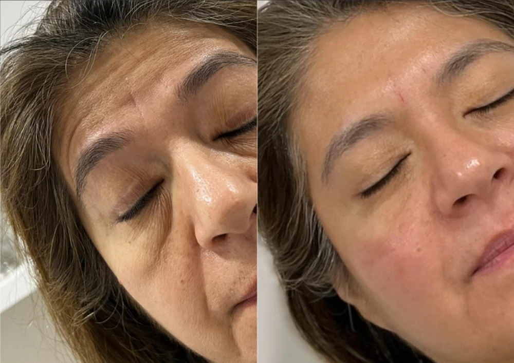 Treatments Antes Despues 01